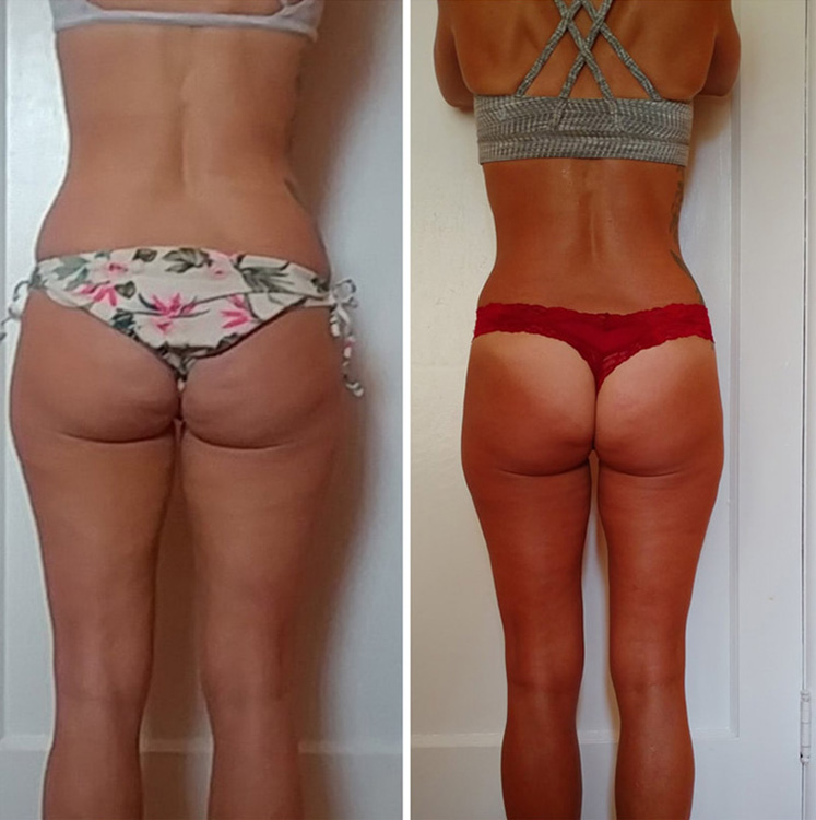 Avant et après les fesses et le dos d'une femme plus toniques après le traitement Slimwave.