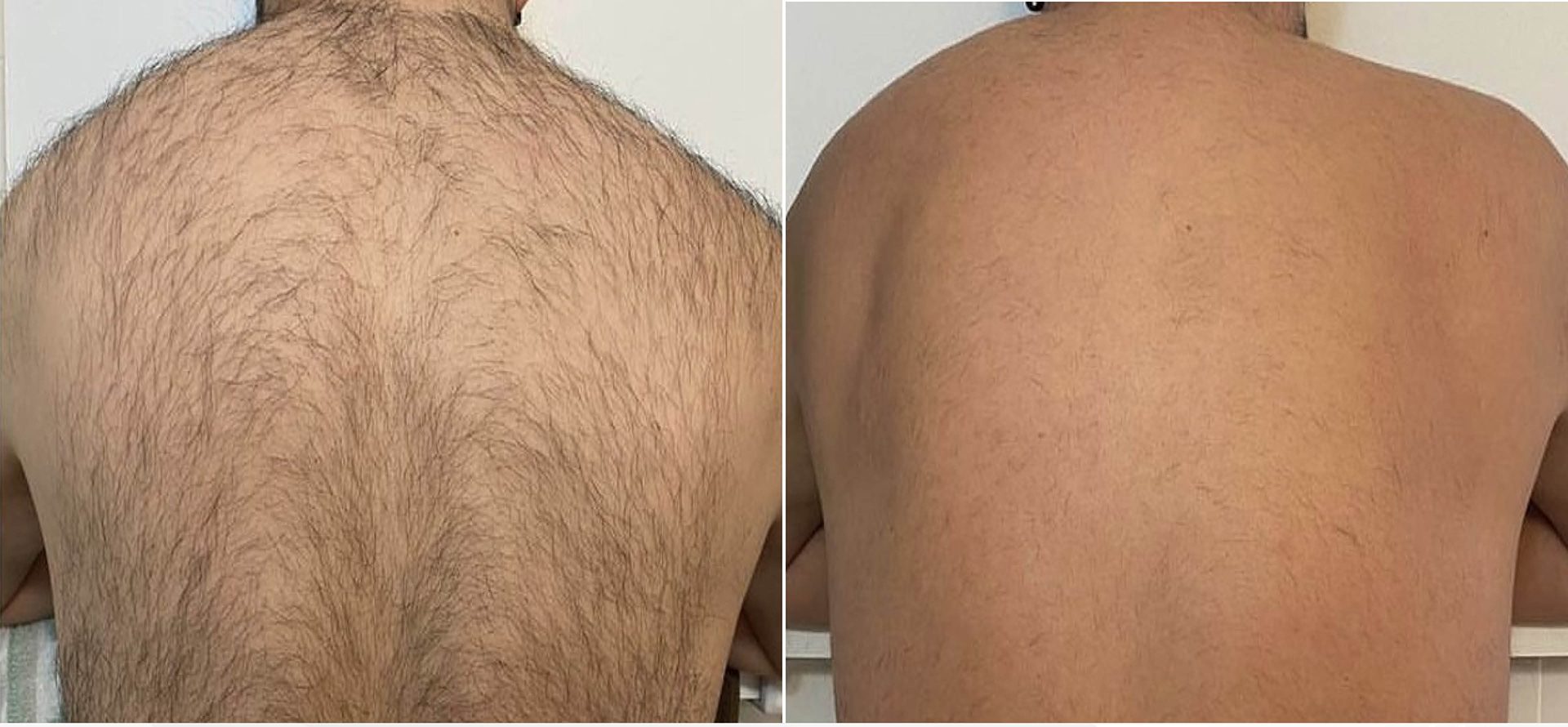 Clarity II laser hair removal before and after, back