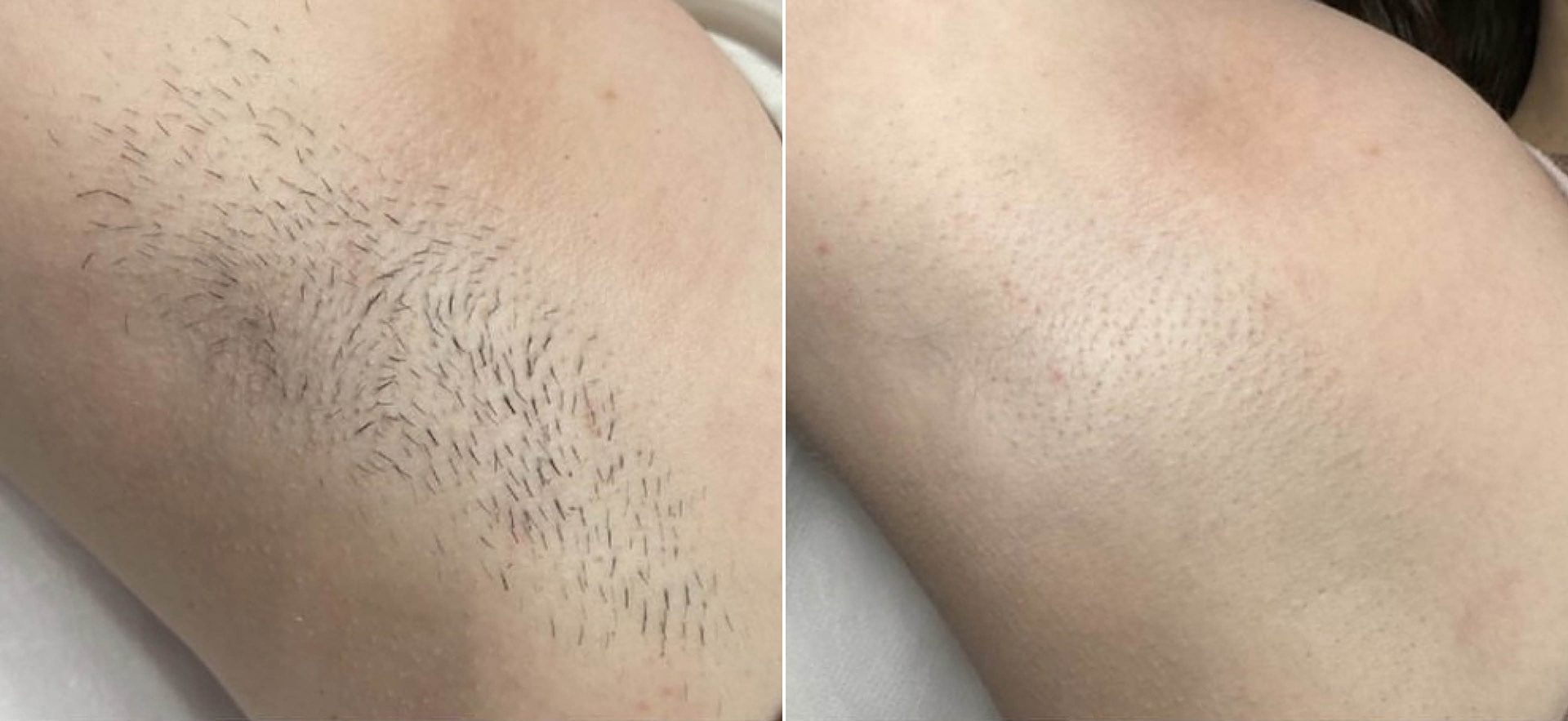 Clarity II laser hair removal before and after, underarm