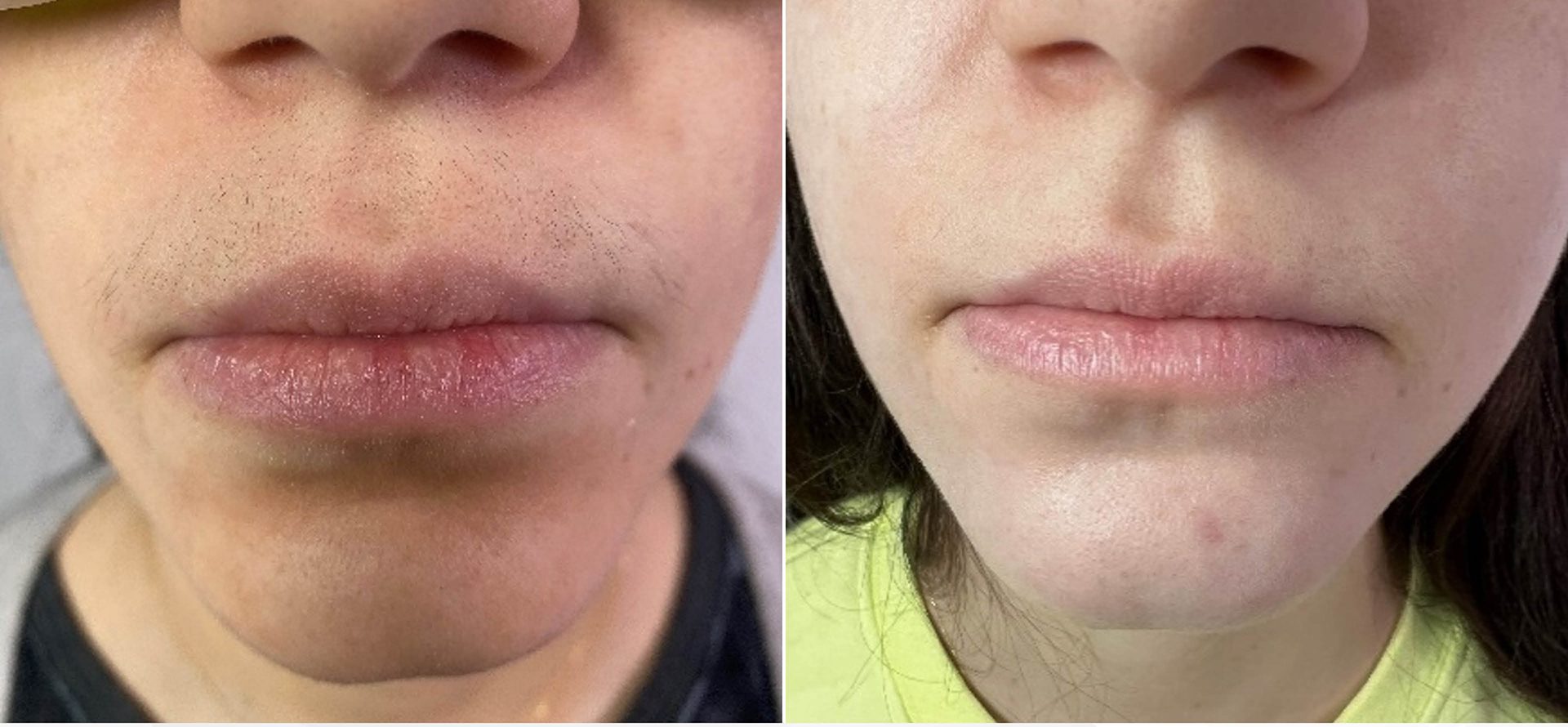 Clarity II laser hair removal before and after, upper lip
