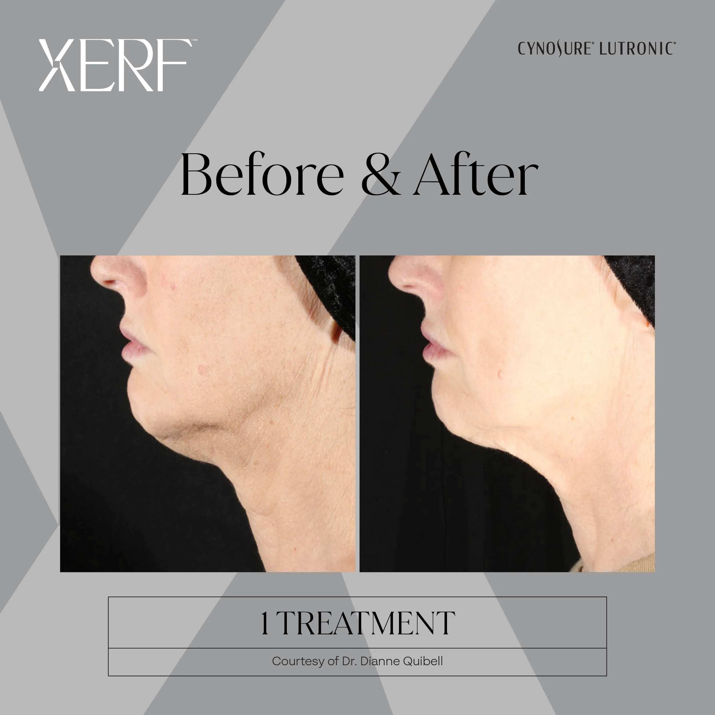 XERF before and after, 2 treatments