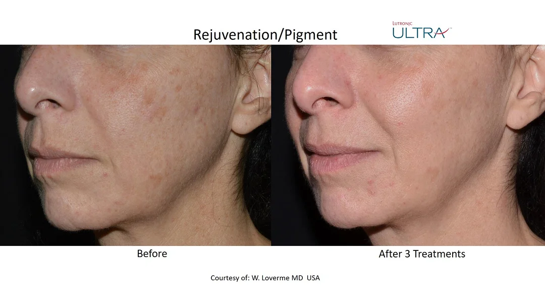 Avant et après : photos montrant l'amélioration de la texture de la peau d'une femme grâce à Laser Ultra MD.