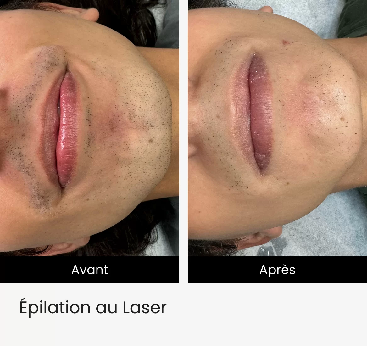 pilation au Laser img 1