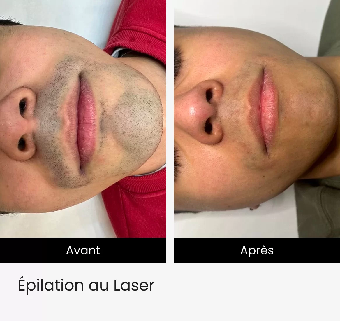 pilation au Laser img 2