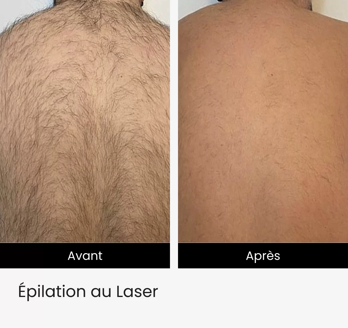 pilation au Laser img 3