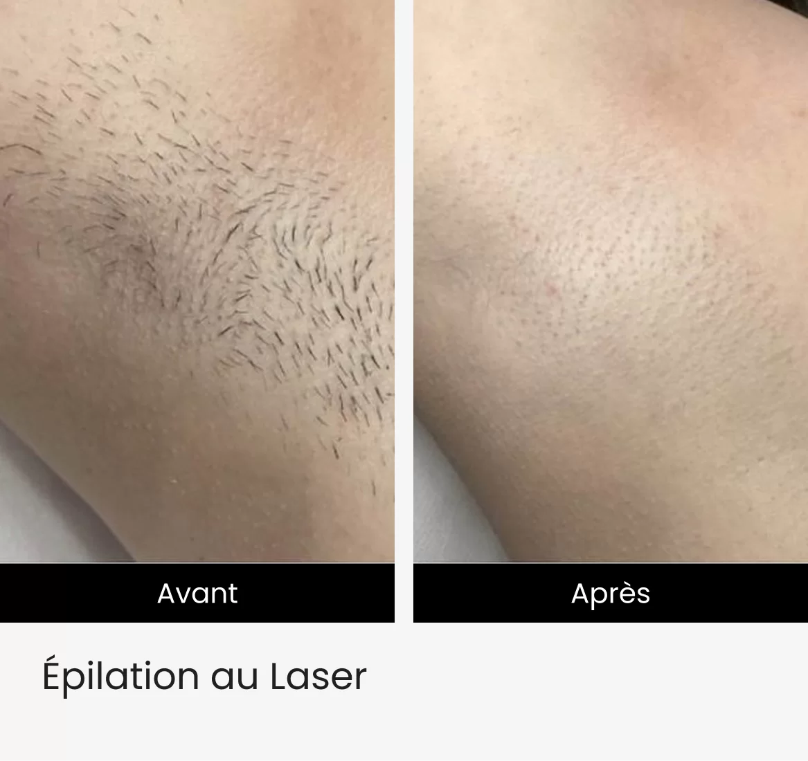 pilation au Laser img 4