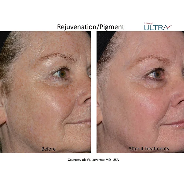 Avant et après le traitement de pigmentation par Laser Ultra MD, montrant une peau visiblement plus uniforme et éclatante.