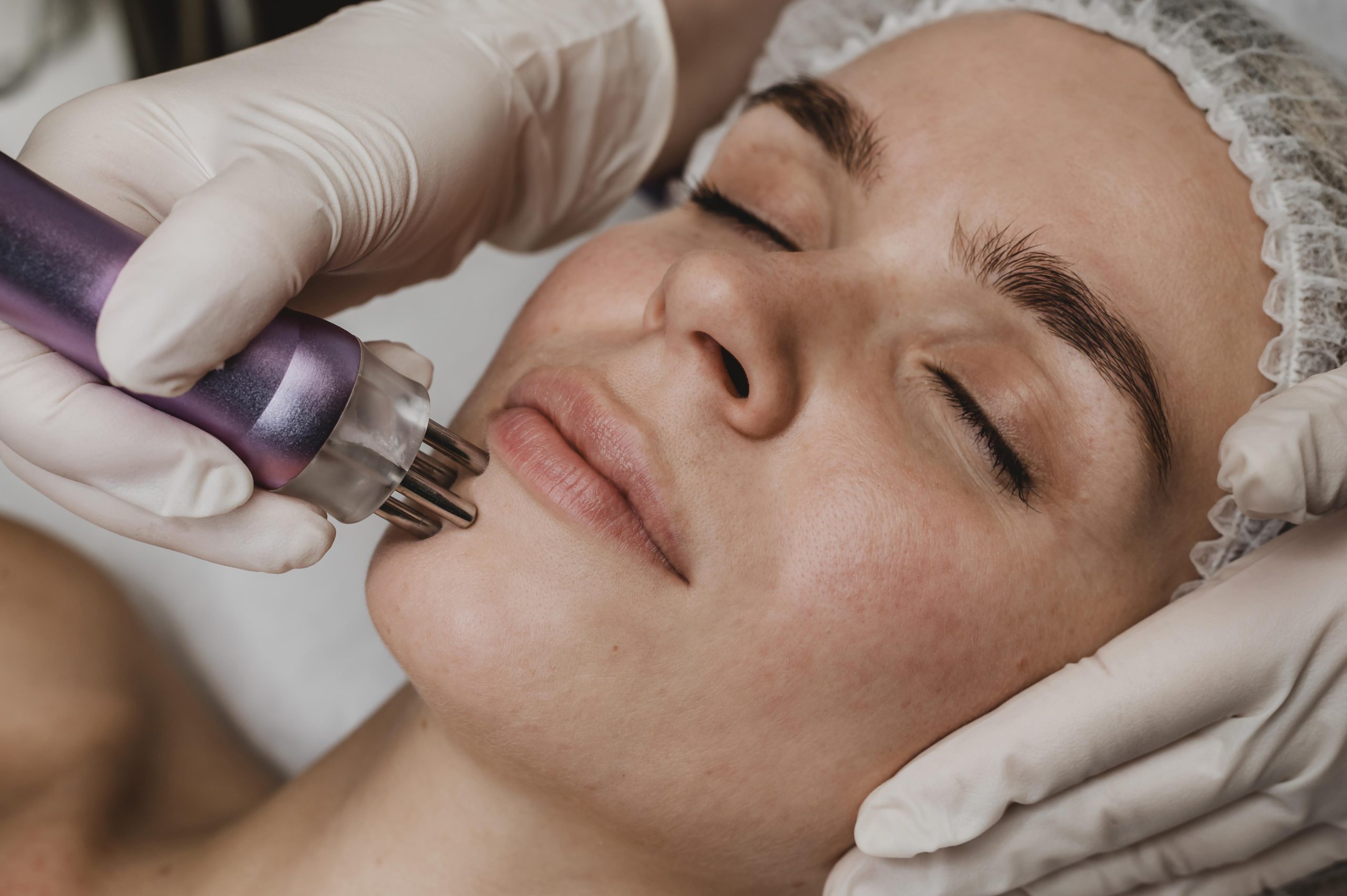 Microneedling Montreal treatment and RF microneedling Montreal